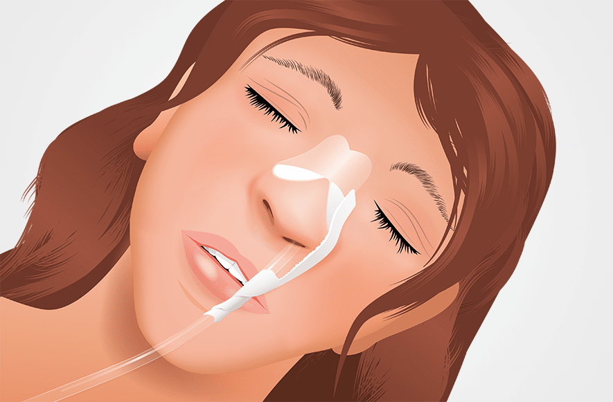 Nasalsondenfixierung Befestigung einer nasalen Magensonde mit Hilfe eines Transafix Nasal Fixiersystems
