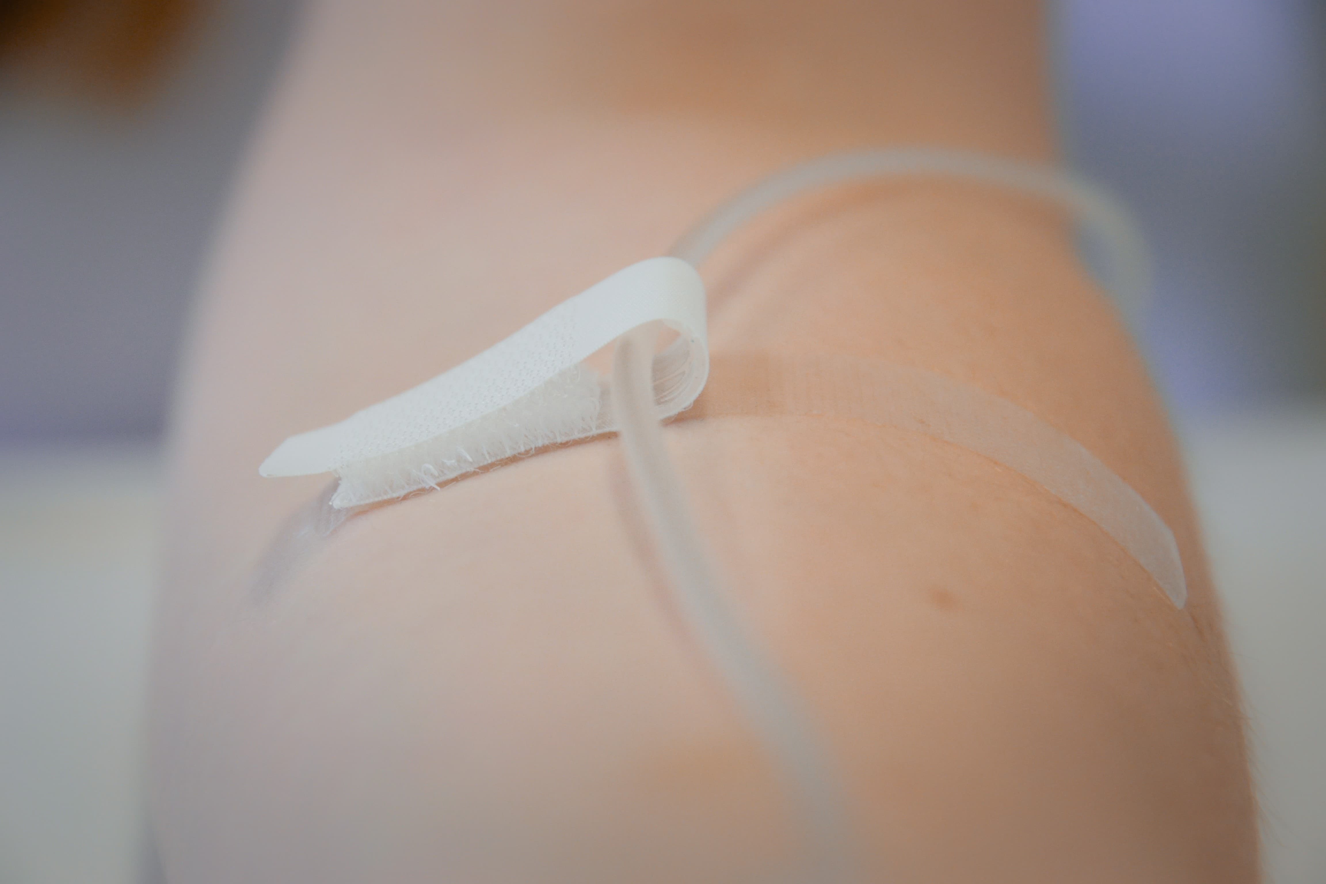 Anwendungsbeispiel der Fixierstreifen No. 1 an einem Arm